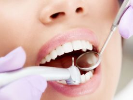 Пломбы и вкладки в лечении зубов